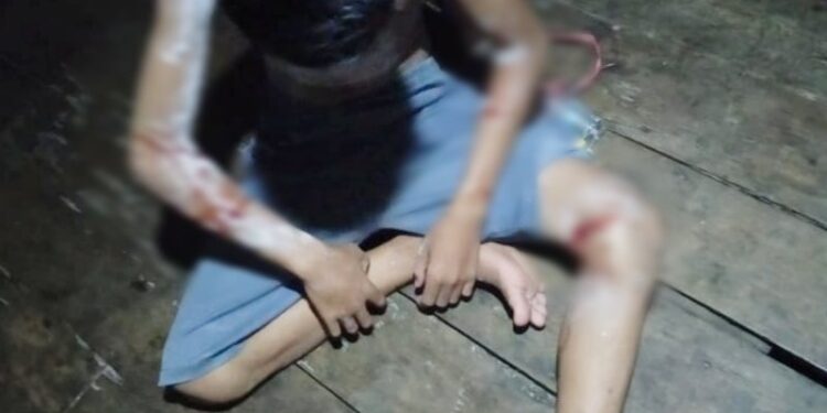 Korban serangan buaya menderita sejumlah luka di sekujur tubuhnya akibat gigitan satwa buas tersebut, Minggu (25/10/2020). (ANT/IST)